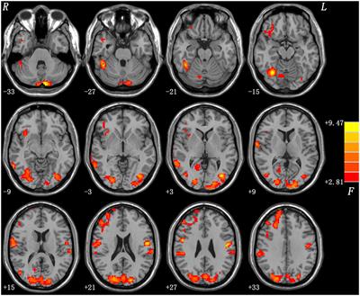 Disrupted Regional Homogeneity in Melancholic and Non-melancholic Major Depressive Disorder at Rest